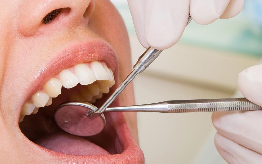 La caries dental: ¿Qué es y qué puedohacer para evitarla?