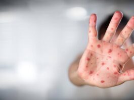 Aumentan casos de viruela del mono en Canadá