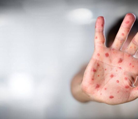 Aumentan casos de viruela del mono en Canadá