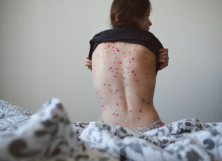 Un caso confirmado y cinco sospechosos de viruela del mono en Toronto