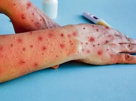 Más de 61 mil 750 casos y una veintena de decesos en el mundo por viruela símica