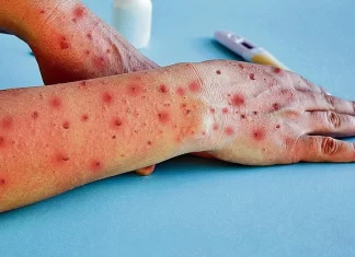 Más de 61 mil 750 casos y una veintena de decesos en el mundo por viruela símica