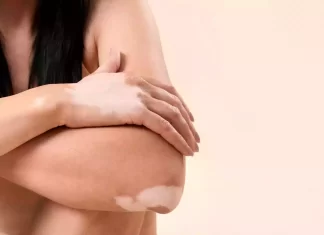 Vitiligo: más allá de la estética