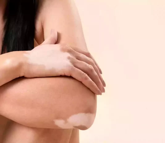 Vitiligo: más allá de la estética
